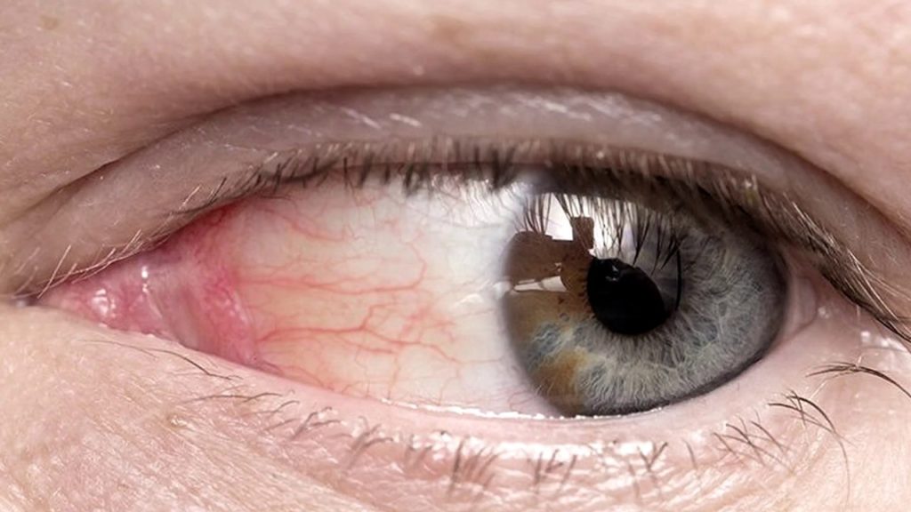 Лечение и профилактика атеросклероза сосудов сетчатки глаза
